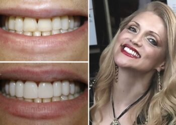 Affordable-Veneers