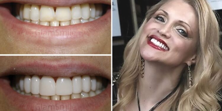 Affordable-Veneers