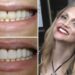 Affordable-Veneers