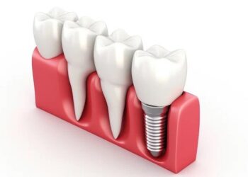 Dental-Implant