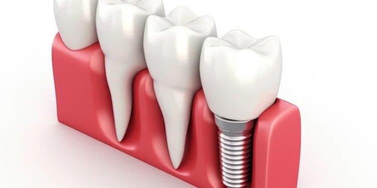 Dental-Implant
