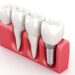 Dental-Implant