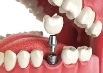 Dental-Implants
