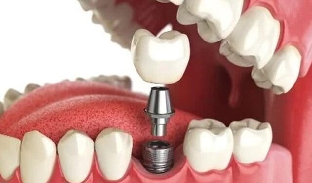 Dental-Implants