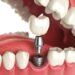 Dental-Implants